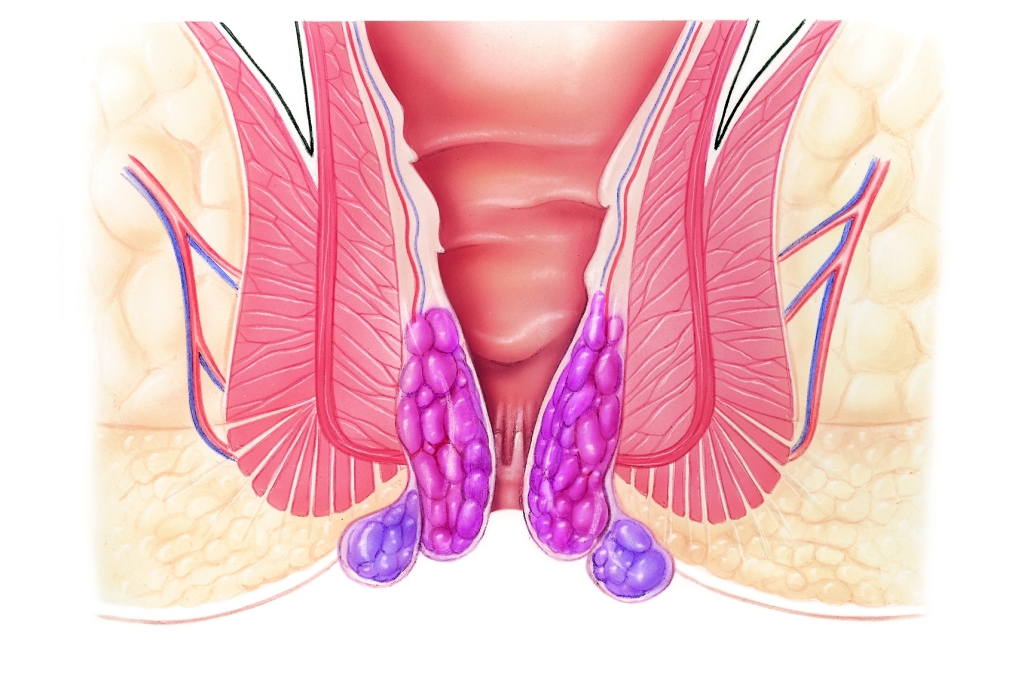 Варикоз Заднего Прохода