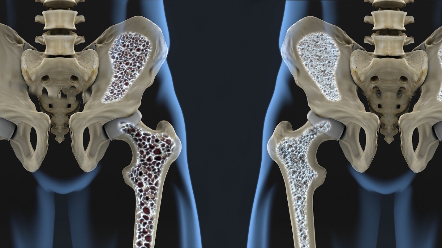 Osteoporoza – “vjedhës i heshtur” i indit kockor