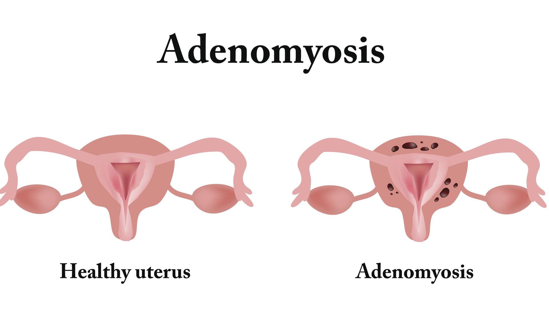 Adenomyoza