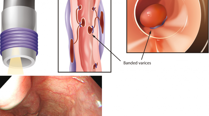 Lidhja e venave varikoze (variçeve) me anë të endoskopisë