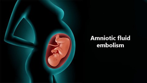 Embolia e Likidit Amniotic (lëngut që rrethon bebin në mitër gjatë shtatzënisë)