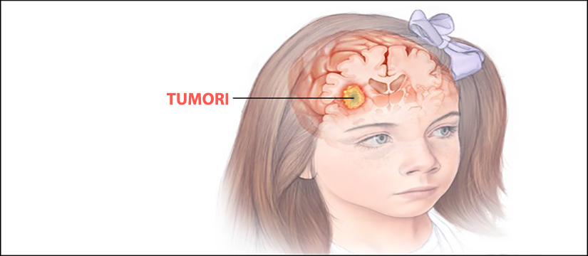 Tumoret e trurit te fëmijët