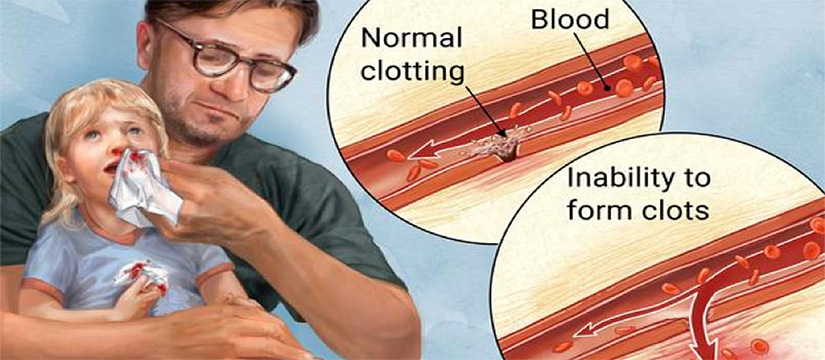 Trajtimi i hemofilisë: Terapia e zëvendësimit